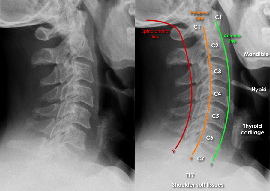 X-Ray Cervical Spine AP and Lat