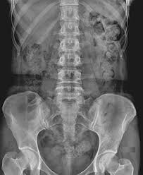 Plain Abdominal Radiography