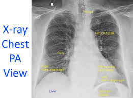 X-RAY CHEST PA VIEW