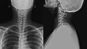 X-Ray Cervical Spine AP and Lat